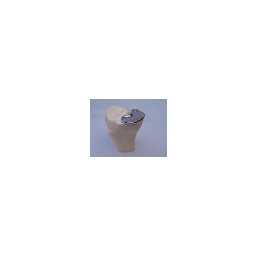 OrthoGlide medial knee implant